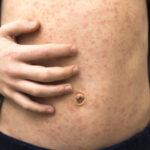 Las enfermeras de Zaragoza hacen un llamamiento a la población a redoblar sus esfuerzos vacunales contra el sarampión