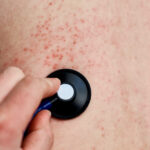 La semFYC alerta del repunte de sarampión en España y llama a reforzar la vacunación con segunda dosis