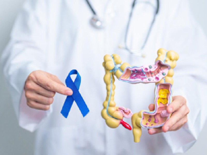dm-cancer-colon-recte.jpg_1810791531