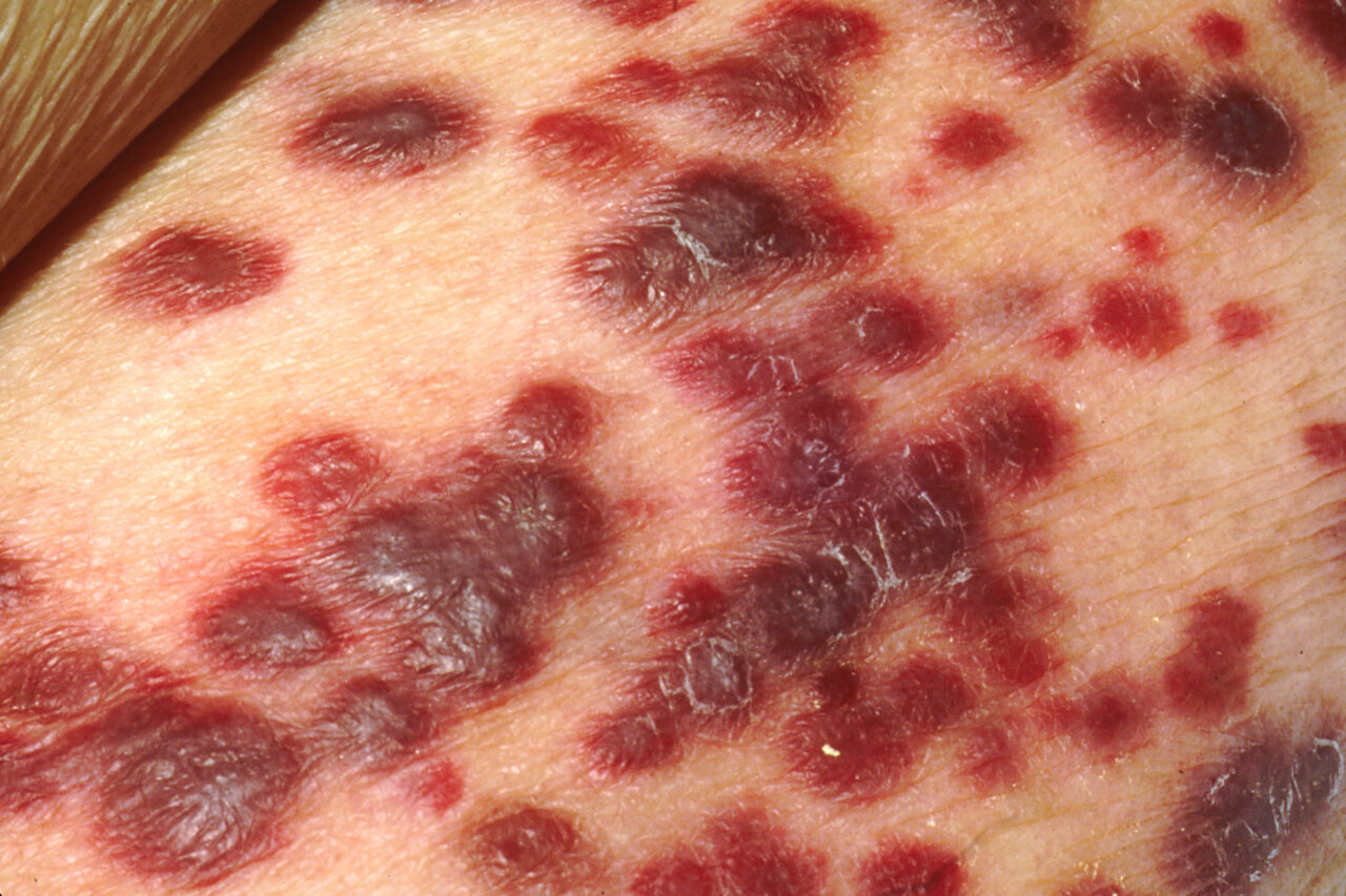 Avances en el tratamiento de sarcomas Imagen de lesiones cutáneas asociadas al sarcoma de Kaposi
